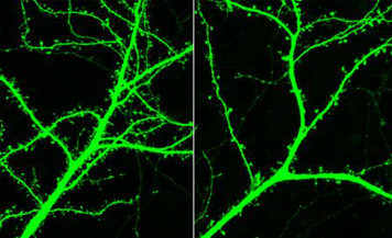 Normal compared to Schizophrenic neuron