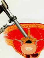 Minimally invasive lumbar spine decompression