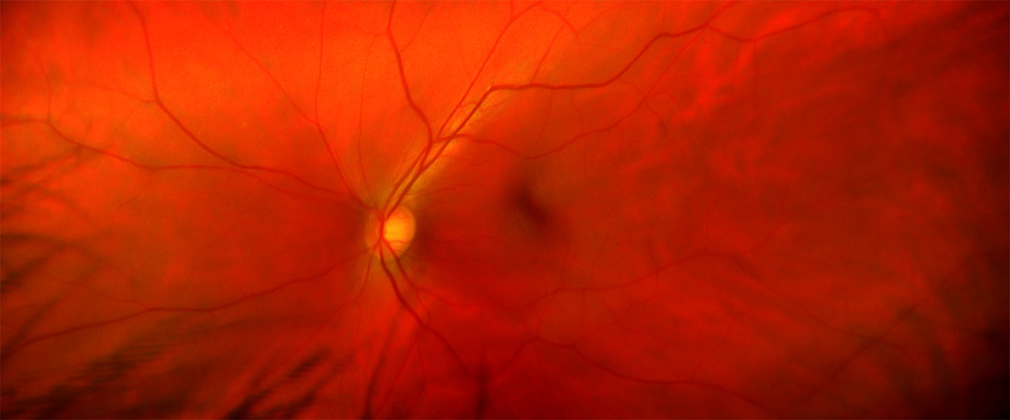 eye_vessels_1440x600.jpg