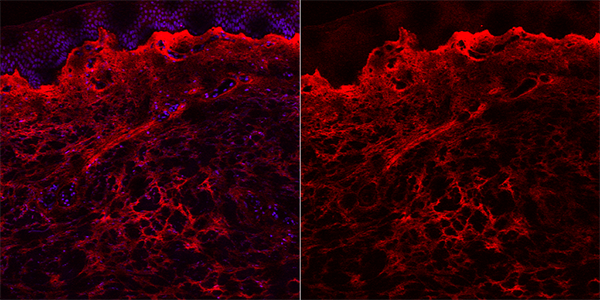 Mechanism Behind Chronic Fibrosis Discovered