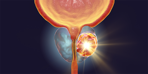 Study Suggests New Strategy to Treat Advanced Prostate Cancer