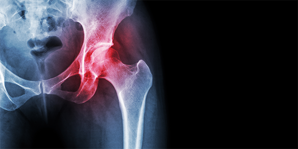 Drug Shows Benefit for Osteoarthritis Patients