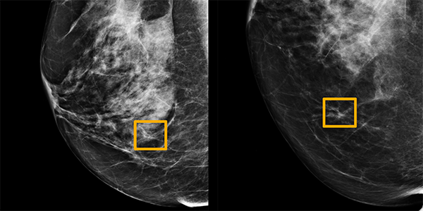 AI Model Improves Breast Cancer Detection