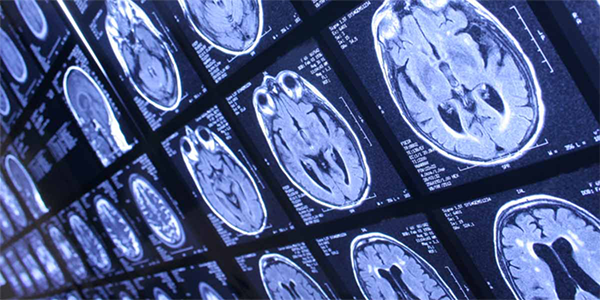 Advancing Deep Brain Stimulation for Parkinson’s Disease