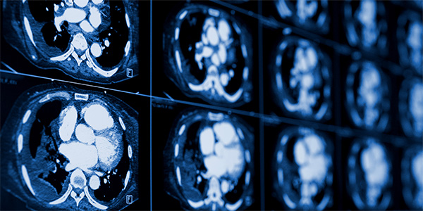 CT Scans Best at Predicting Heart Disease Risk in Middle Age