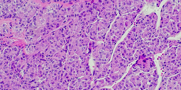 Combining Immunotherapy and Radiation in Soft Tissue Sarcoma