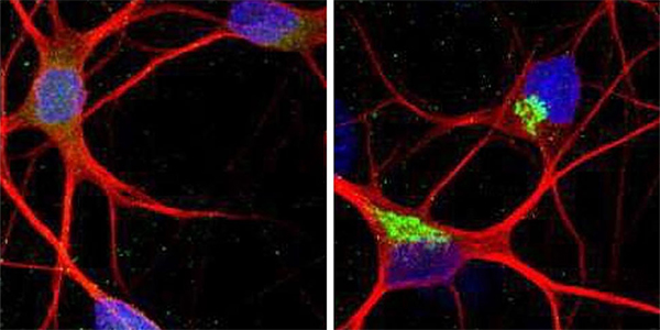 A New Clue to ALS and FTD: Faulty Protein Disrupts Brain’s ‘Brake’ System