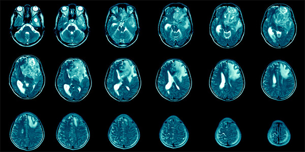 Identifying Immune Pathways Driving Aggressive Brain Cancers