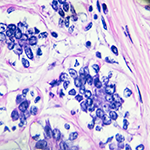 AI may spare breast cancer patients unnecessary treatments