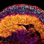 Study Identifies Molecular Mechanisms of Rare Neurodevelopmental Disorder