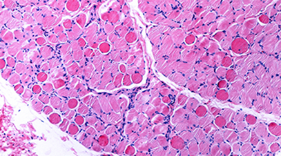 Muscular dystrophy in muscle tissue 