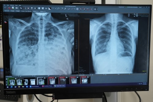 Cornelia Tischmacher lung x-rays before and after transplant
