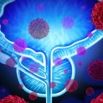 Identifying Biomarkers to Guide Prostate Cancer Treatment